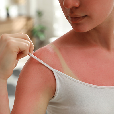 Prevent sunburn